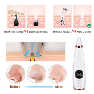 microcry stalline blackhead remover